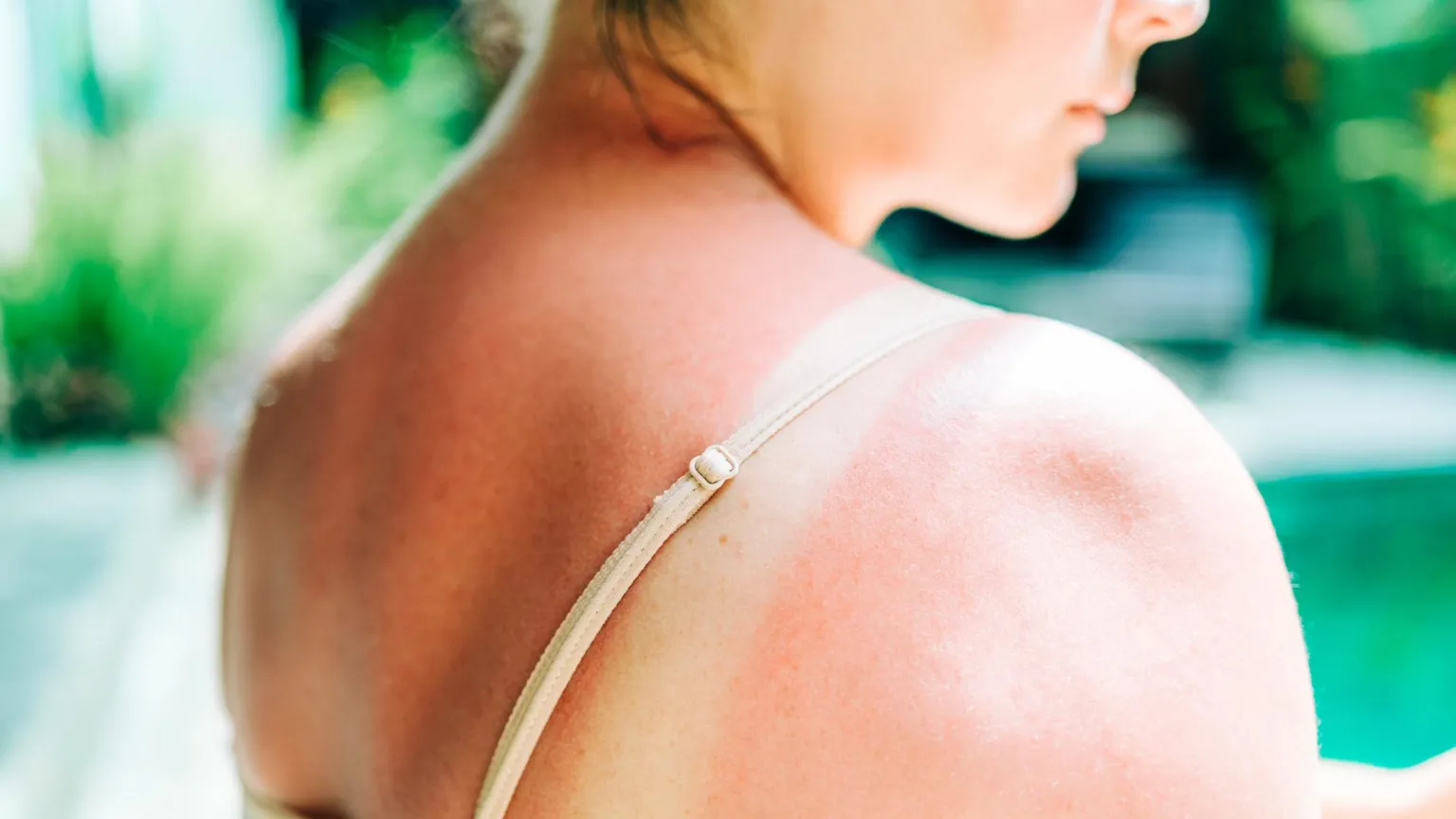 Getty Images A close up photo showing a young woman with sunburn on her back and shoulders